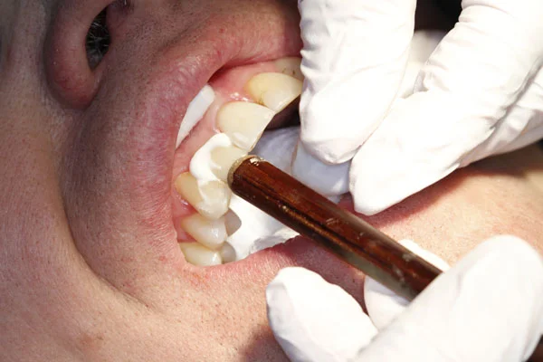 Fig. 6) The crown was cemented firmly into place, and the dual cure resin cement was light cured.