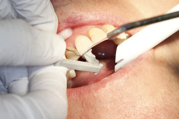Fig. 9) The Gray Final Polishing Strip is then used, both to confirm Interproximal Relief and to polish the surface of the crown to a natural finish.