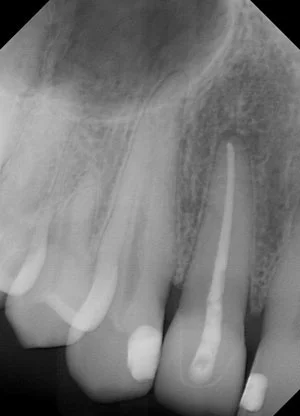 Fig. 12) The x-ray shows the complete marginal seating of the crown after cementation. Using the ContacEZ Restorative Strip System easily produces complete marginal seating with every crown.
