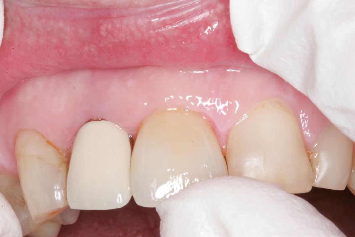 Fig. 1) A ceramic crown was placed on Tooth #8 and pressed up to the prepared margin. There was resistance to seating the crown against the prepared margin.