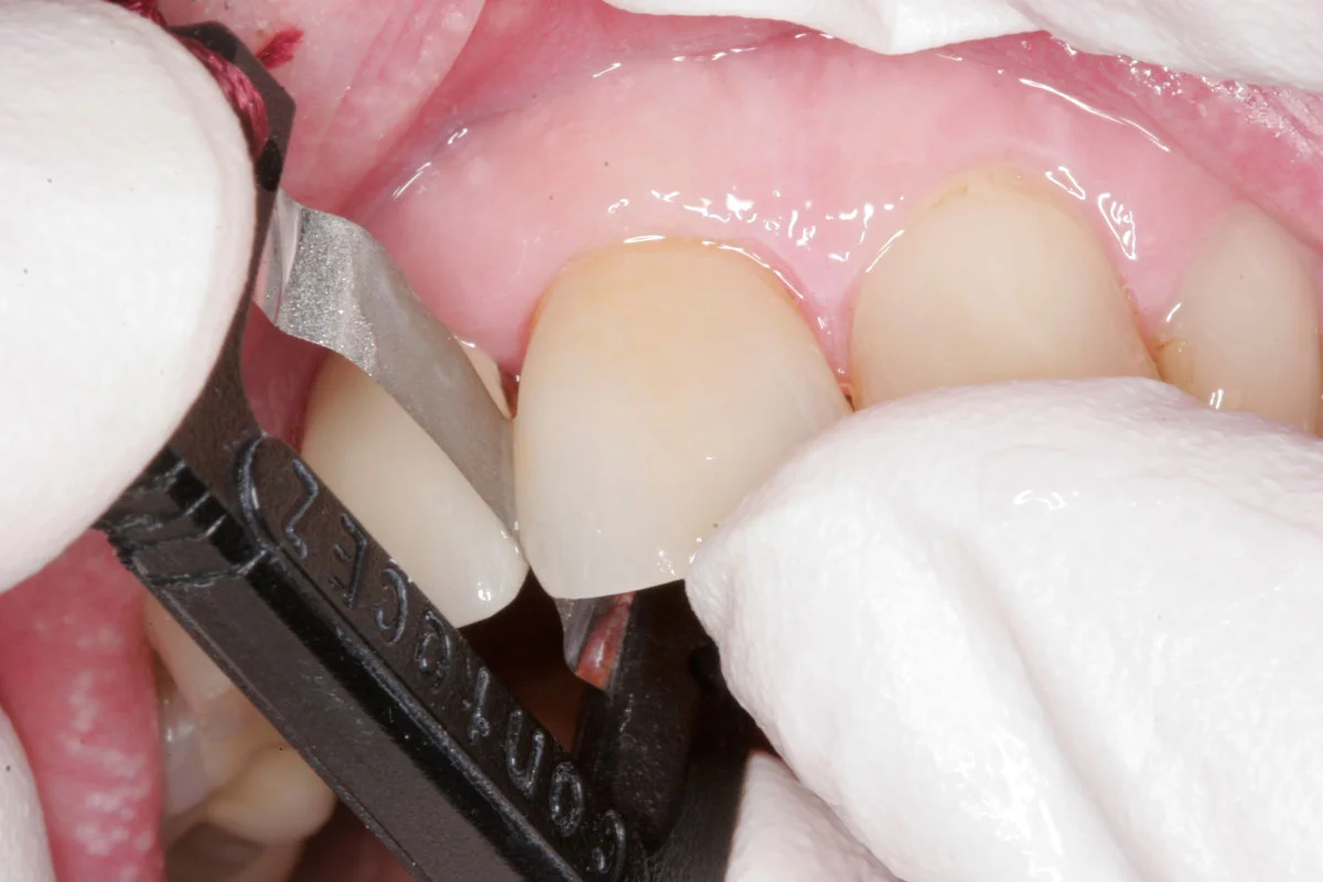 Fig. 2) To find the side of the heavier proximal contact among mesial and distal, ContacEZ Diamond Dental Strip, the ideal proximal contact solution (Black) was inserted into the mesial and distal interproximal spaces facing the abrasive side to the crown and passed buccolingually a few times. The side with more pressure against the strip is the side of heavier proximal contact and needed more relief.