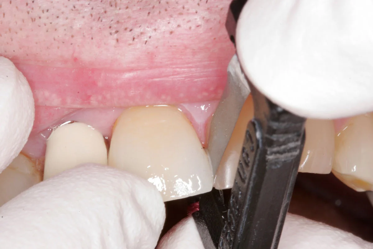 Fig. 3) More pressure was detected in the mesial than the distal interproximal space and ContacEZ Diamond Dental Strip was passed buccolingually a few more times (or 5-6 times) through the mesial interproximal space. This procedure was repeated in the mesial and distal interproximal space until there was light resistance in both of the interproximal spaces. When light resistance in both the mesial and distal interproximal spaces was equal, the ideal proximal contact adjustment of the crown on Tooth #8 was completed.