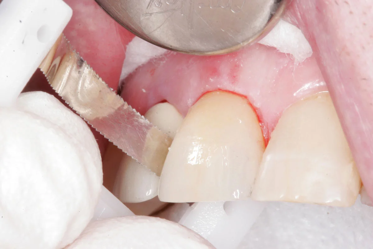 Fig. 5) The excess resin cement around the crown was removed with an explorer. ContacEZ Serrated Dental Strip, the interproximal space cleaner (White), was passed through...