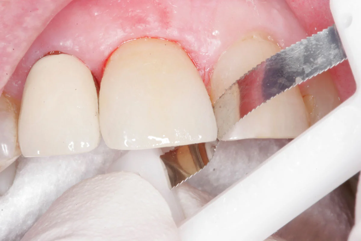 ...to cut and clean out the remaining resin cement in the distal and mesial interproximal spaces.