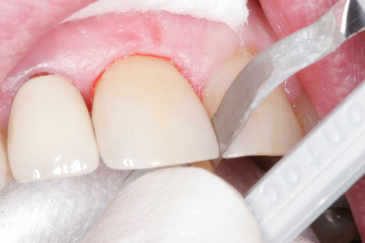 Fig. 6) Using ContacEZ Final Polishing Strip, the final proximal surface polisher (Gray), the mesial and distal proximal surfaces were polished.