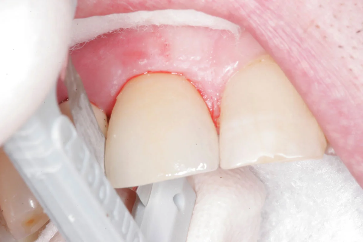 Fig. 7) The ideal proximal contacts are confirmed using dental floss. The dental floss was passed through the interproximal contacts with heavy resistance - snapping in and out. The crown seating of Tooth #8 was completed.