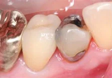 Fig. 2) The crown was lifted from the prepared tooth and rested passively between the adjacent teeth. There was a marginal opening due to overly tight contacts and it was found that the mesial margin had less opening, which indicated that there was more pressure in the mesial interproximal space.