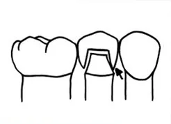 Fig. 3) The crown was slightly lifted and a ContacEZ Diamond Dental Strip was inserted into the mesial interproximal space that had the heavier contact. The crown was gently finger pressed. The ContacEZ Diamond Dental Strip was passed with the abrasive surface facing the crown, buccolingually 6 times. The crown seated with each pass of the ContacEZ Diamond Dental Strip.