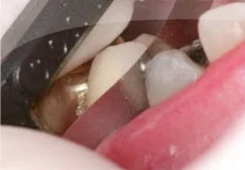 The orientation of the diamond particles on the metal strip may initially limit the movement of the strip to one direction. The crown was visible through the opening of the ContacEZ Diamond Dental Strip. This opening allowed easy access for an additional instrument to press down the loose crown while the ContacEZ Diamond Dental Strip was passed buccolingually.