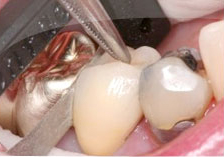 Fig. 4) Then the ContacEZ Diamond Dental Strip was moved to the distal part of the crown and inserted into the interproximal space. The ContacEZ Diamond Dental Strip was passed twice buccolingually. Because there was light resistance to the distal, it was not necessary to pass the strip more than twice.