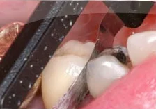 Fig. 5) Again, the ContacEZ Diamond Dental Strip was moved to the mesial of the crown and inserted into the interproximal space. It was passed 5-6 times with light resistance to ContacEZ Diamond Dental Strip. The crown was seated completely to the margin of the preparation. The side with the most resistance to ContacEZ Diamond Dental Strip was the heavier contact side and may require more passes of the strip.