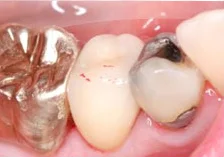 Fig. 11) The occlusion was evaluated and adjusted. There was no extrusion of the adjacent teeth.