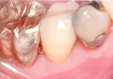 Fig. 12) Crown cementation was finished.