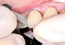 Fig. 6) The ContacEZ Diamond Dental Strip was inserted into the distal interproximal space of crown #8. With the abrasive side facing the crown, the ContacEZ Diamond Dental Strip was passed through faciolingually 2 to 3 times.