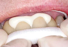 Fig. 7) ContacEZ Diamond Dental Strip was inserted into the distal interproximal space of crown #9 with the abrasive surface towards crown and passed through faciolingually 2 to 3 times. Procedures 4 to 7 were repeated until the ContacEZ Diamond Dental Strip was passed through with light resistance.