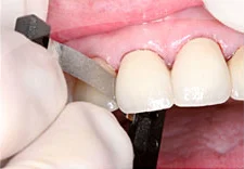 Fig. 9) After excess cement was thoroughly removed, the ContacEZ Diamond Dental Strip was inserted into the mesial and distal interproximal spaces of teeth #8 and 9, and Interproximal Relief was confirmed.
