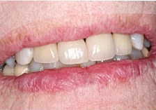 Fig. 10) The crown cementation was completed.