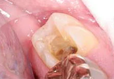 Fig. 1) Tooth #18 was prepared for MO inlay. The primer was applied in the preparation and light cured.