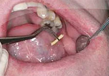 Fig. 2) A piece of gingival retraction cord was prepared for the subgingival margin of the preparation.