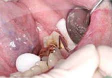 Fig. 3) The retraction cord was inserted into the sulcus of the mesial interproximal space of tooth #18 to expose the gingival margin of the preparation.