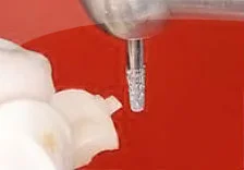 Fig. 4) An inlay body was milled in the CEREC machine, and the sprue and its elevated surroundings were removed thoroughly.
