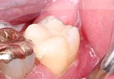 Fig. 5) The inlay body was placed in the preparation. It was found that the inlay was incompletely seated due to excessively heavy proximal contact. Note the opening of the gingival margin in the mesial proximal embrasure of tooth #18.