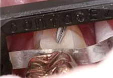 Fig. 8) The ContacEZ Diamond Dental Strip was passed through buccolinually 23 times while the inlay body was gently pressed, until light resistance was achieved. At first, the strip moved in one direction only due to excessively heavy proximal contact. Therefore, the ContacEZ Diamond Dental Strip was passed approximately the first 10 times in one direction only by making a circular motion and was gradually able to pass in both directions buccolingualy.