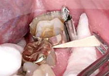 Fig. 9) A matrix band was installed with a wedge and the inlay body was cemented with light cure resin cement.