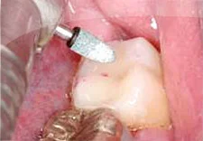 Fig. 11) The excess cement was removed and the occlusion was adjusted.