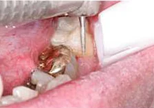 Fig. 12) Using a finishing point, the margins of the restoration were smoothed to conform evenly to the enamel surface of the tooth.