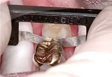 Fig. 13) The Interproximal Relief was confirmed by using the ContacEZ Diamond Dental Strip.
