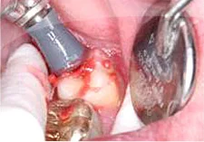 Fig. 15) Tooth #18 was polished.