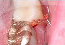 Fig. 16) The retraction cord was removed.