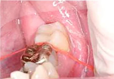 Fig. 17) The interproximal space was cleaned using dental floss.