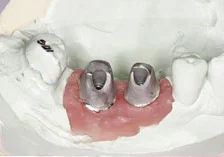 Fig. 1) It is extremely important to instruct your dental lab to retain the natural contour and space between the adjacent teeth. The models should not be scraped. If scraping is required, it should not exceed 0.10 mm in thickness.