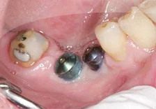 Fig. 2) Tooth #31 was cleaned and Teeth #29, 30, and 31 were ready for definitive cementation.