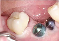 Fig. 3) Crown #31 was placed on the prepared abutment tooth and seated with finger pressure. The margin of the crown fits to the preparation and occlusion was evaluated.
