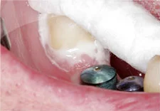 Fig. 4) Crown #31 was cemented with firm finger pressure.