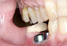 Fig. 5) The cement was removed from Tooth #31 and occlusion was evaluated with articulating film.