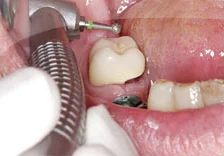 Fig. 6) The occlusion was adjusted.