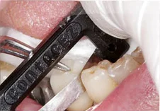 Fig. 9) Crown #30 was removed from the abutment and Crown #29 was placed on the abutment supported by the implant. ContacEZ Diamond Dental Strip was inserted into the mesial interproximal space of Tooth #29 with the abrasive surface facing the crown. The ContacEZ Diamond Dental Strip was passed approximately 18 times until it passed with light resistance. (Interproximal Relief was achieved)