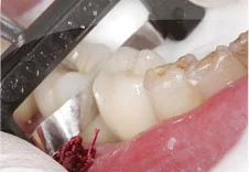Fig. 10) Crown #30 was placed on the abutment and ContacEZ Diamond Dental Strip was inserted between Crowns #29 and 30 and passed buccolingually 16 times with the abrasive side facing the crown until the ContacEZ Diamond Dental Strip passed with light resistance. The abrasive surface faced Crowns #29 and 30 alternately.