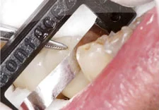 Fig. 12) ContacEZ Diamond Dental Strip was inserted into the mesial interproximal space of Tooth #30 confirming interproximal relief.