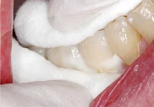 Fig. 14) Crowns #29 and 30 were cemented with firm finger pressure.