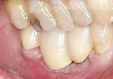 Fig. 17) Cementation of Crowns #29, 30, and 31 was completed and the patient confirmed immediate comfort and functionality.