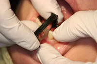 Fig.1 A newly fabricated crown is placed on the abutment of tooth #23 and the proximal contact is adjusted by using the fine diamond Black Strip while the crown is held by a finger.