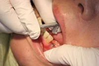 Fig.4 The finest diamond Gray Strip is used to polish the proximal surfaces of the crown to its natural texture and to confirm Interproximal relief.