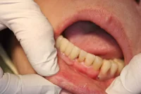 Fig.5 The proximal contact between crown #22 and resin tooth #21 of the lower partial denture is adjusted using Black Diamond Strips until light resistance is felt.