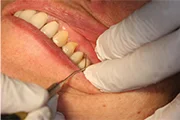 Fig. 2 Using an explorer, the tighter interproximal margin, mesial or distal, is determined. With this crown, the distal margin is tight, touching the dentin surface of the abutment, but the mesial margin is slightly open, and the tip of an explorer can sneak in.
