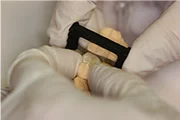 Fig. 3 The crown is brought to the stone working model, and the Black Diamond Strip is used to adjust the distal proximal contact surface of the crown before trying the fit in the patient's mouth again. This process is repeated until the Strip gets into the interproximal space in the patient's mouth. Pushing the adjacent stone tooth towards the crown against the strip can accelerate abrasion.